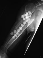 Antibiotic beads