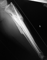 Antibiotic rod