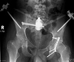Uniplanar pelvis external fixator