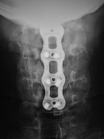 Anterior cervical fusion plate - AP view