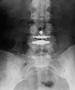 Metal-on-polyethylene disk replacement