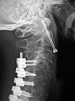 Odontoid screw (nail) fixation with posterior cervical plates and screws
