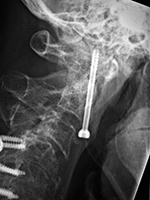 Odontoid nail flexion view