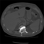 Thoracic CT. Vetebral cage and screw in spinal canal