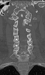 Posterior cervical screws are in facet jonts