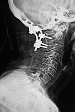 Sagittal CT-failure of cervical spine fusion