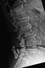 ILIF at L4-5. Lateral view in extension