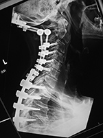 Occiput to T8 posterior spinal fixation before
