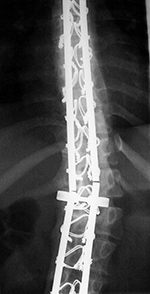 Spinal fixation rods fractures