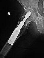 Dynamic compression screw lateral view