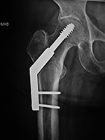 Hip Dynamic Compression Screw