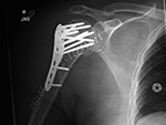 Right humerus periarticular locking plate