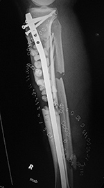 Right tibia bone graft