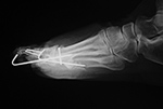 Smart Toe implants