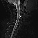 Truncation artifact