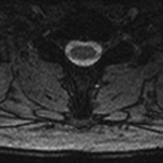 Truncation artifact