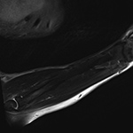 Shading artifact