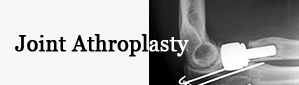 Joint Arthroplasty
